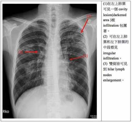 右肺钙化灶是什么意思?提示动脉硬化 右肺钙化灶是什么意思