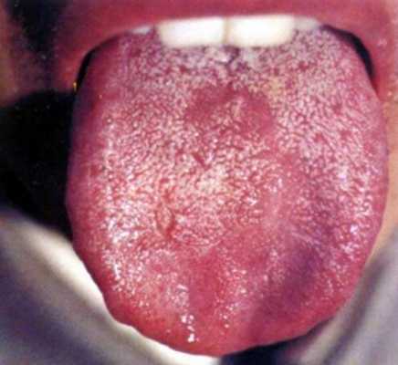 舌头发涩的10大疾病征兆 女性舌头发涩吃什么药