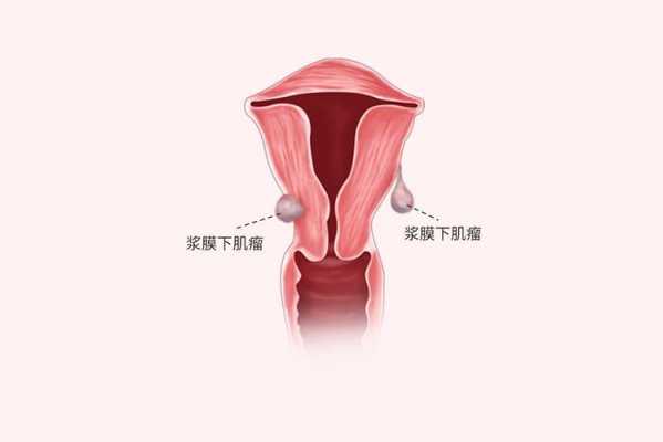  子宫瘤和子宫肌瘤有什么区别「哪种女人容易得子宫肌瘤」