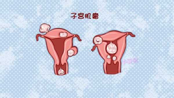  子宫瘤和子宫肌瘤有什么区别「哪种女人容易得子宫肌瘤」