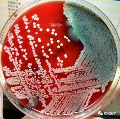 金黄色葡萄球菌是什么症状-金黄色葡萄球菌是什么