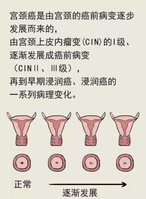 宫颈高级别病变是什么意思,宫颈高级别病变是什么意思切除子宫会变老吗? 