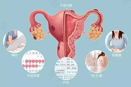 子宫内膜异位症有什么症状表现