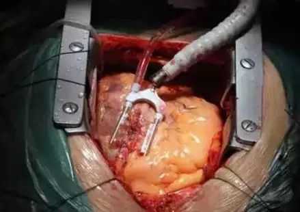 为什么做心脏支架手术三个月了还有少量的积水-为什么要做心脏支架手术