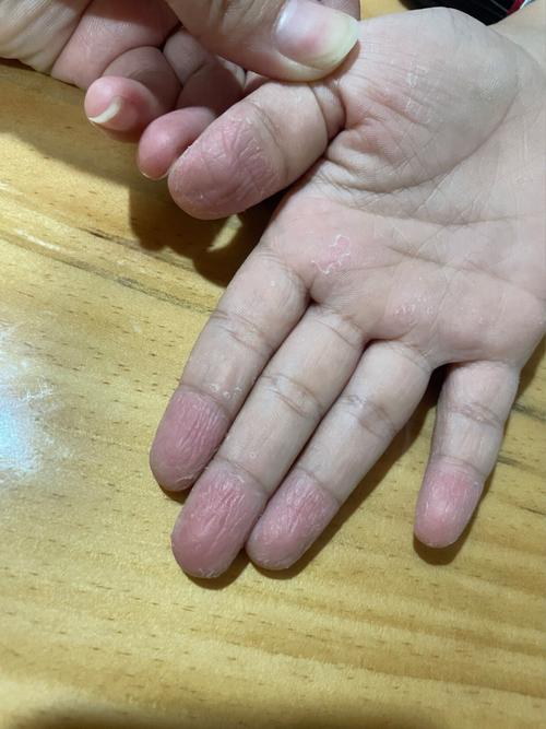 宝宝手指脱皮是什么原因导致的