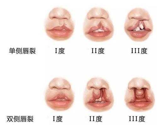  唇干唇裂是什么原因造成的「唇干唇裂是什么引起的」