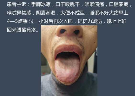 舌头边缘有齿痕是什么原因（口苦舌头边缘有齿痕是什么原因）